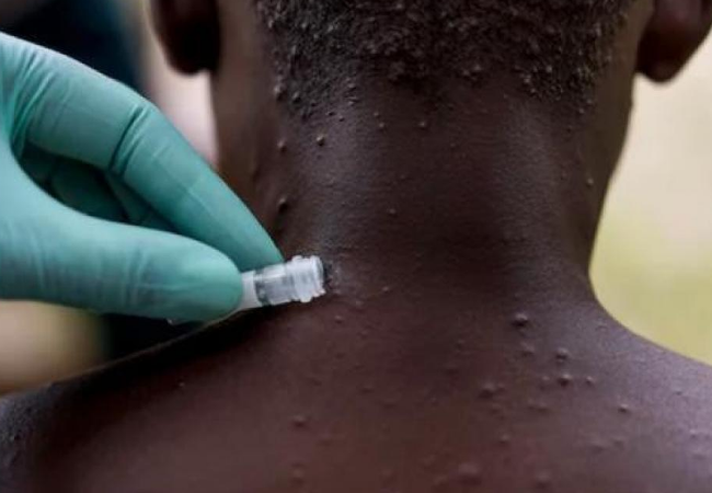 وصول جدري القرود إلى لبنان